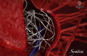 Arissa Medical announces 12-month clinical results with Syntra device in complex brain aneurysms